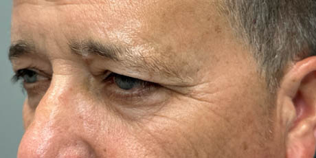 1_0008_patient 21 before quad bleph with CO2, facial fat grafting and direct brow lift- left side.png