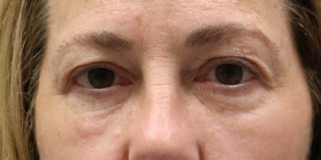 1_0008_patient 24 before quad bleph with facial fat grafting and CO2 laser- front.png