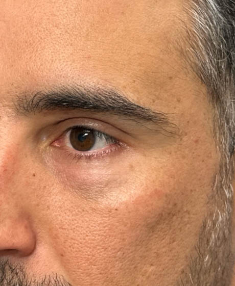 1_0008_patient 61 before lower bleph with facial fat grafting and ultraclear laser- side.png