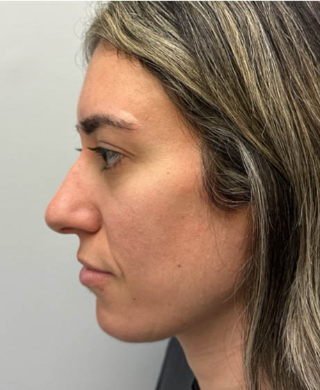 1_0009_patient 17 after chin filler.png