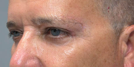 1_0009_patient 21 after quad bleph with CO2, facial fat grafting and direct brow lift- left side.png