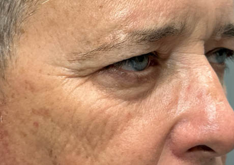 1_0009_patient 21 before quad bleph with CO2, facial fat grafting and direct brow lift- right side – Copy.png