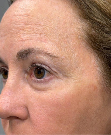 1_0009_patient 22 after quad bleph with facial fat grafting and CO2 laser- side.png