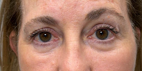 1_0009_patient 24 after quad bleph with facial fat grafting and CO2 laser- front.png