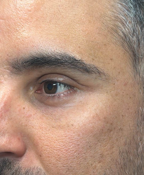 1_0009_patient 61 after lower bleph with facial fat grafting and ultraclear laser- side.png