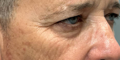 1_0010_patient 21 before quad bleph with CO2, facial fat grafting and direct brow lift- right side – Copy.png