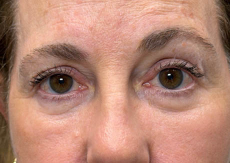 1_0010_patient 22 after quad bleph with facial fat grafting and CO2 laser- front.png