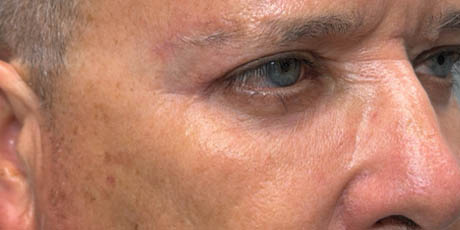 1_0011_patient 21 after quad bleph with CO2, facial fat grafting and direct brow lift- right side.png