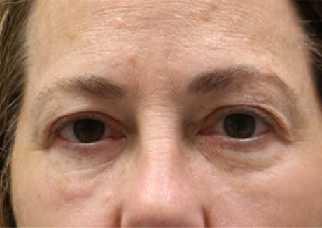 1_0011_patient 22 before quad bleph with facial fat grafting and CO2 laser- front.png