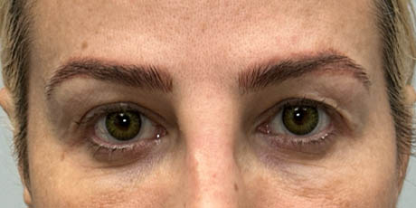 1_0012_patient 22 before upper bleph with subbrow fat grafting, temporal browlift – front.png