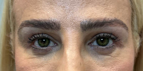 1_0013_patient 22 after upper bleph with subbrow fat grafting, temporal browlift – front.png