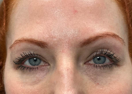 1_0013_patient 23 before upper bleph with subbrow fat grafting, temporal browlift and CO2 laser- front.png