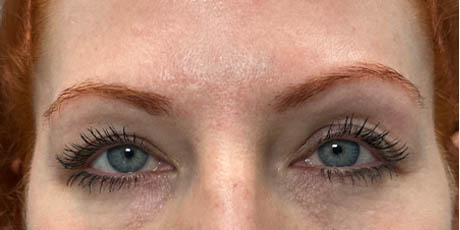 1_0014_patient 23 before upper bleph with subbrow fat grafting, temporal browlift and CO2 laser- front.png