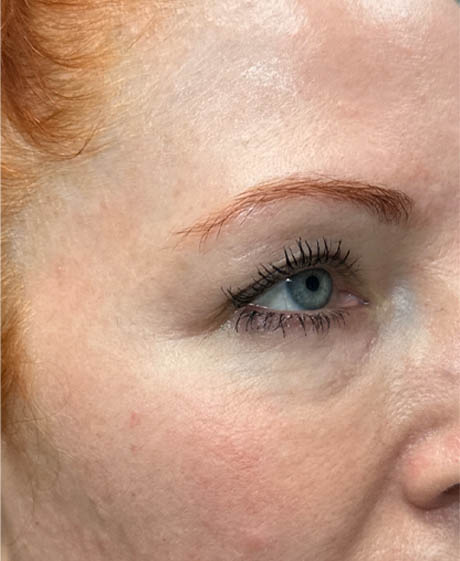 1_0014_patient 23 before upper bleph with subbrow fat grafting, temporal browlift and CO2 laser- side.png