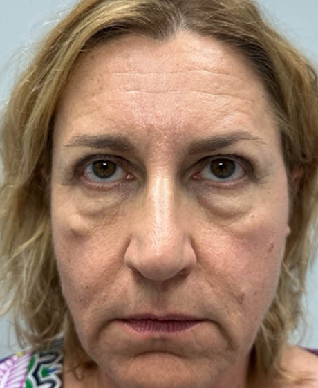 1_0014_patient 62 before lower bleph with facial fat grafting.png