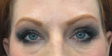 1_0015_patient 23 after upper bleph with subbrow fat grafting, temporal browlift and CO2 laser- front.png