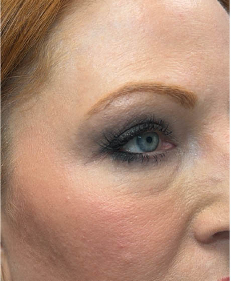 1_0015_patient 23 after upper bleph with subbrow fat grafting, temporal browlift and CO2 laser- side.png