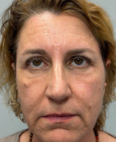 1_0015_patient 62 after lower bleph with facial fat grafting.png