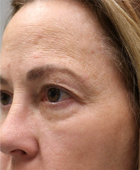 1_0016_patient 22 before quad bleph with facial fat grafting and CO2 laser- side.png