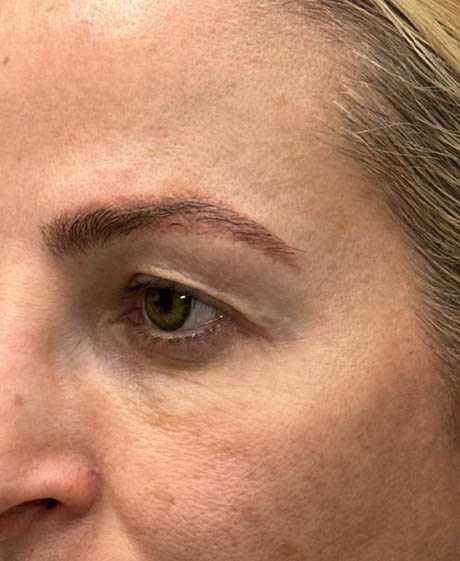 1_0016_patient 22 before upper bleph with subbrow fat grafting, temporal browlift – side.png