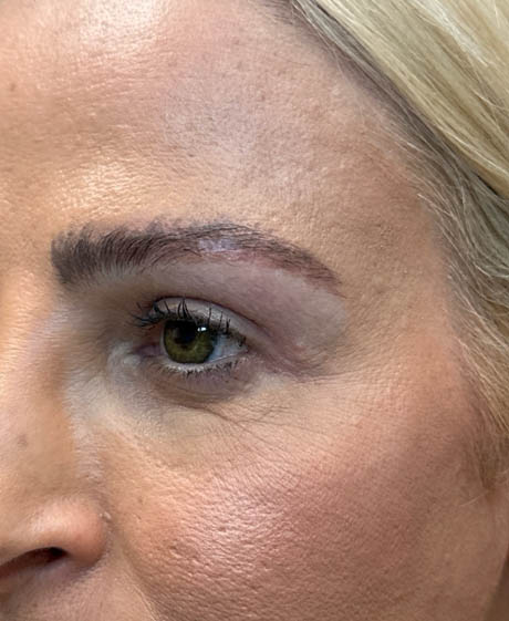 1_0017_patient 22 after upper bleph with subbrow fat grafting, temporal browlift – side.png