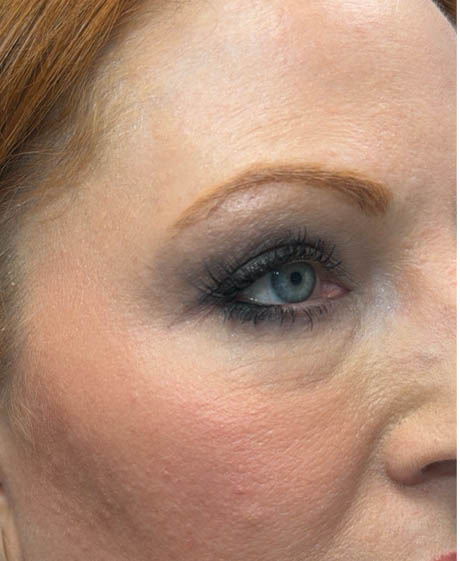 1_0019_patient 23 after upper bleph with subbrow fat grafting, temporal browlift and CO2 laser- side.png