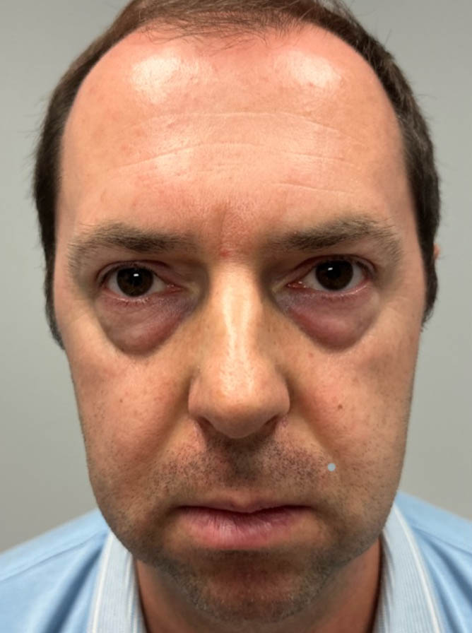 1_0000_before-front lower bleph with facial fat grafting.png
