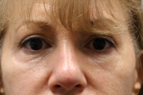 1_0000_patient 4 before cheek filler.PNG