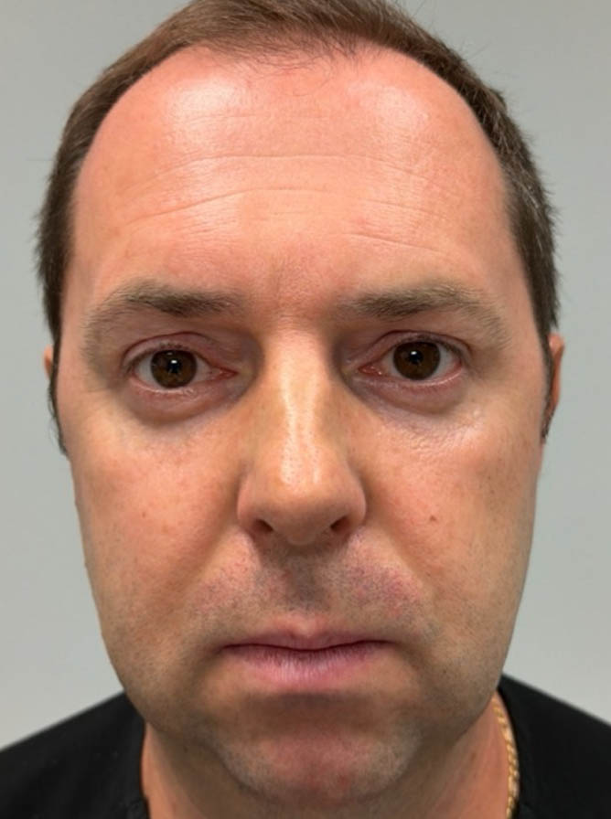 1_0001_after lower bleph with facial fat grafting-front.png