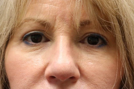1_0001_patient 4 after cheek filler.PNG