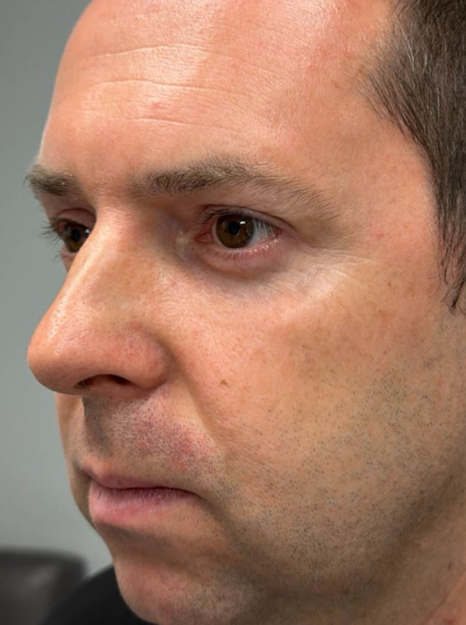 1_0002_after- lower bleph with facial fat graftingside.png