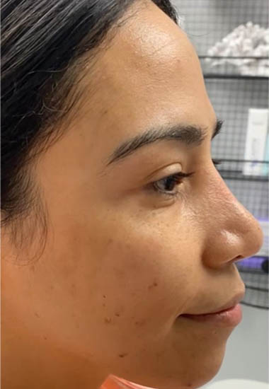 1_0002_patient 1 before IPL (1 session) right side.PNG