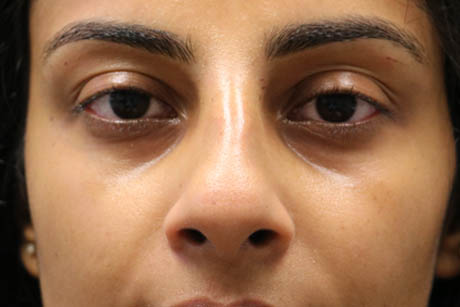 1_0002_patient 5 before cheek filler.PNG