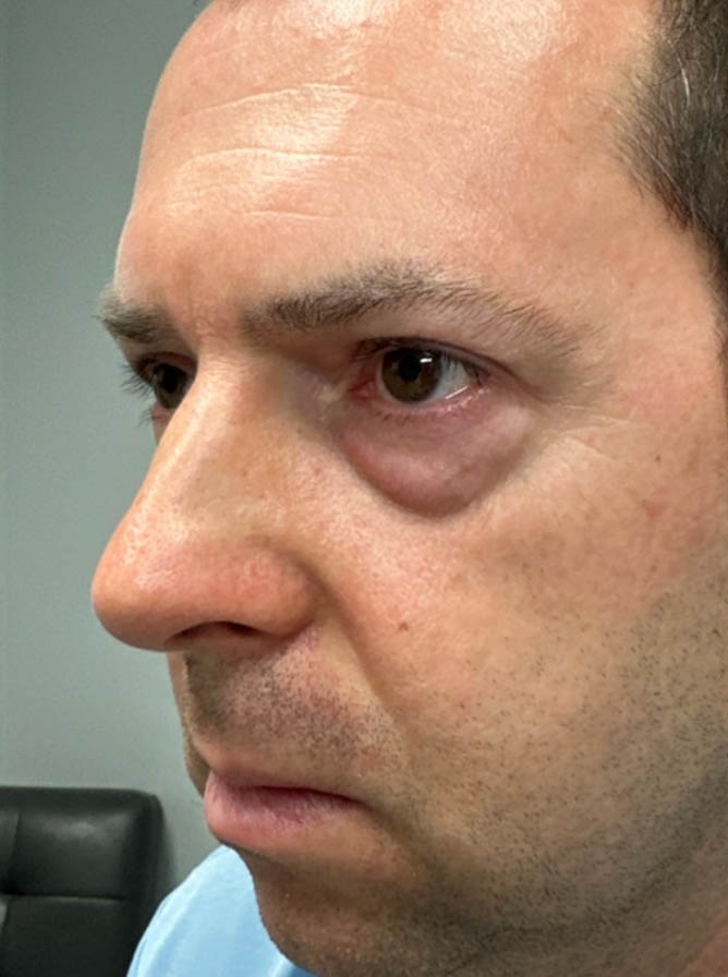 1_0003_before-sidelower bleph with facial fat grafting.png
