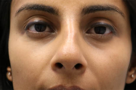 1_0003_patient 5 after cheek filler.PNG