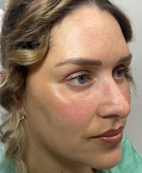 1_0003_patient after lower bleph with fat grafting and CO2- side.jpg