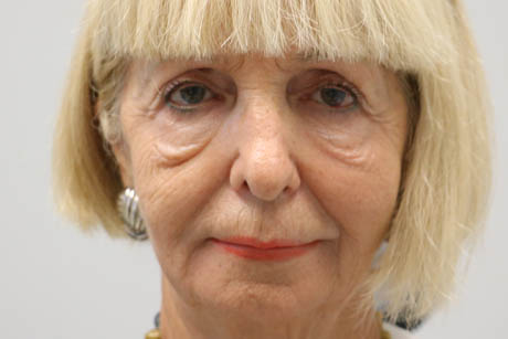 1_0004_patient 2 before cheek filler.PNG