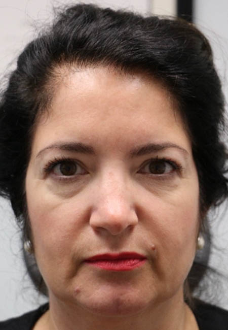 1_0006_patient 3 before cheek filler.PNG