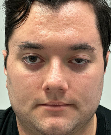 1_0008_FULL FACE BEFORE M8 .png
