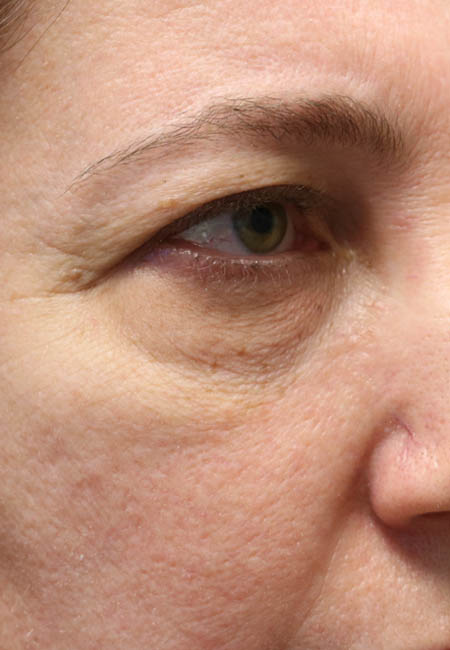 1_0008_paitent 6 before cheek filler.PNG