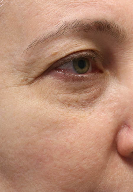 1_0009_paitent 6 after cheek filler.PNG