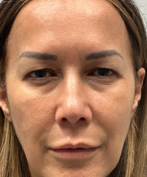 1_0010_BEFORE UPPER BLEPH AND PTOSIS REPAIR.png