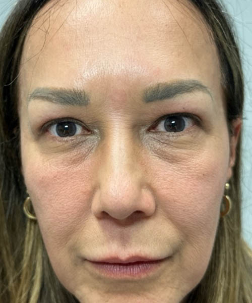 1_0011_AFTER UPPER BLEPH AND PTOSIS REPAIR.png