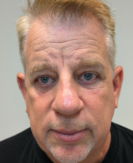 after lower bleph with fat transfer and CO2 laser- front.png