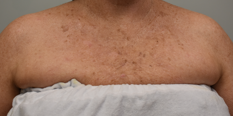 patient 4 after IPL chest.PNG