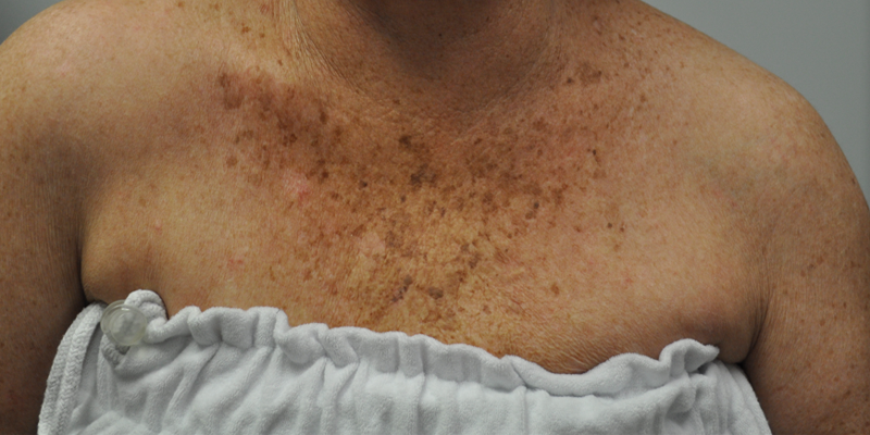 patient 4 before IPL chest.PNG