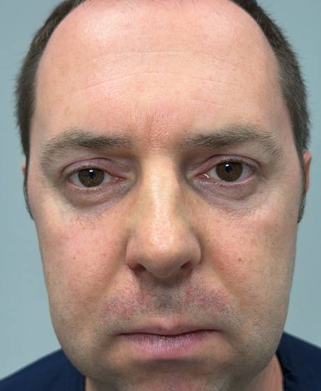 patient 60 after lower bleph with facial fat grafting- front