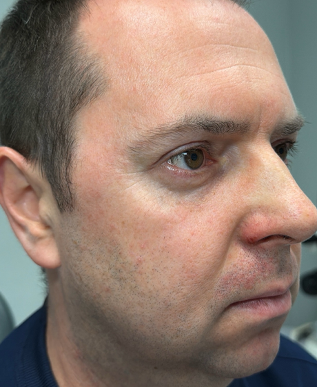 patient 60 after lower bleph with facial fat grafting- side