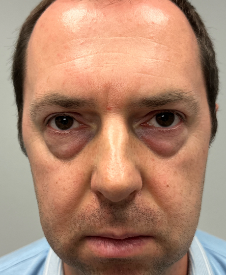 patient 60 before lower bleph with facial fat grafting- front