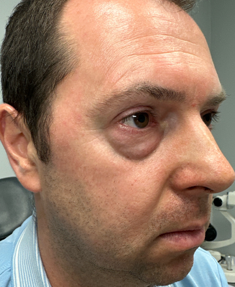 patient 60 lower bleph with facial fat grafting- side